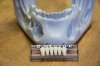 Endo-teeth2.jpg